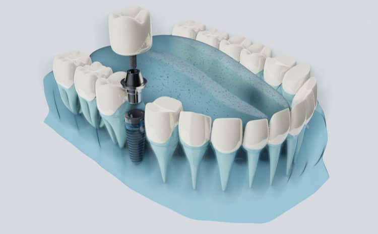 Featured image for “Dental Implants Risks to Consider Before Surgery”