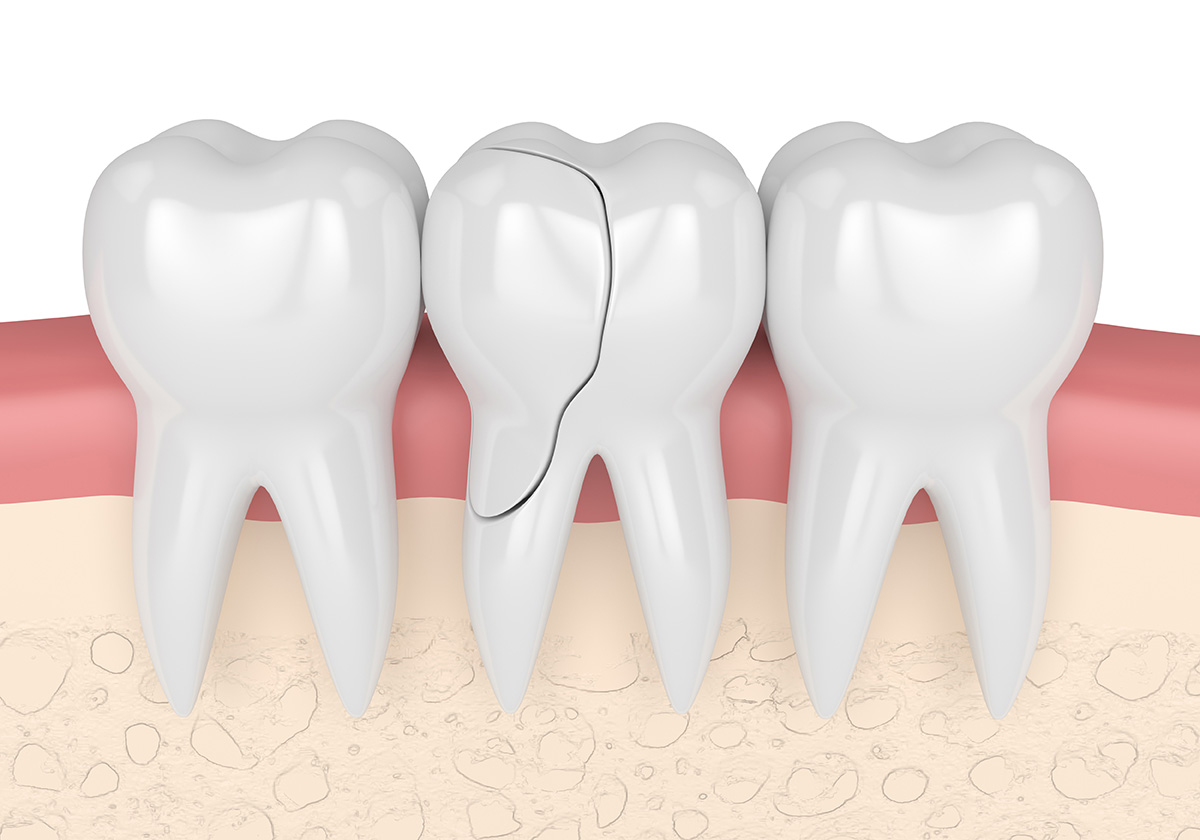 Featured image for “Ways to Repair Broken or Cracked Tooth”