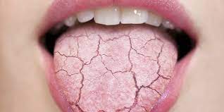 Featured image for “8 Home Remedies For Dry Mouth”
