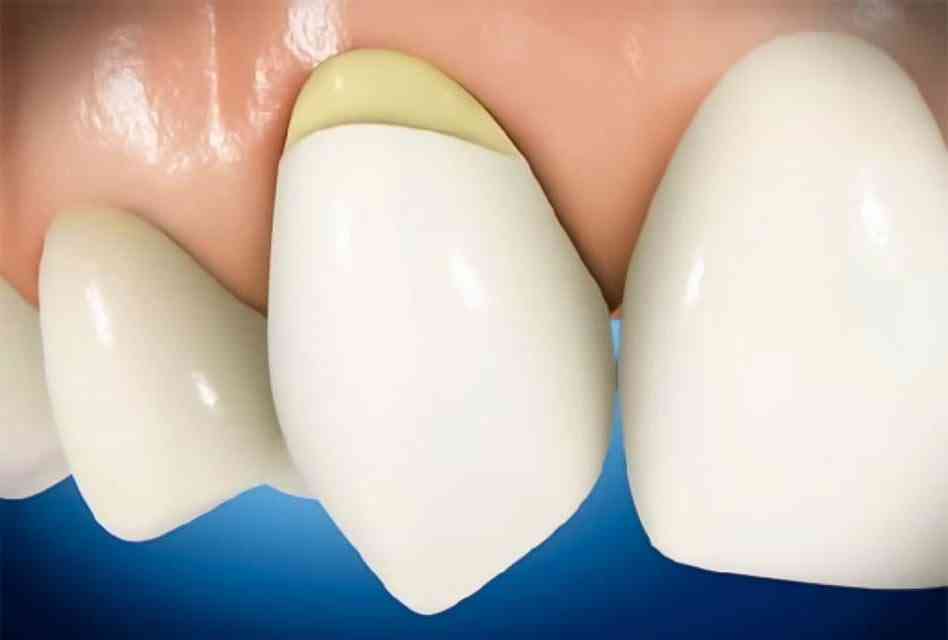 Featured image for “Dental Abrasion: What is it and do You Need it?”