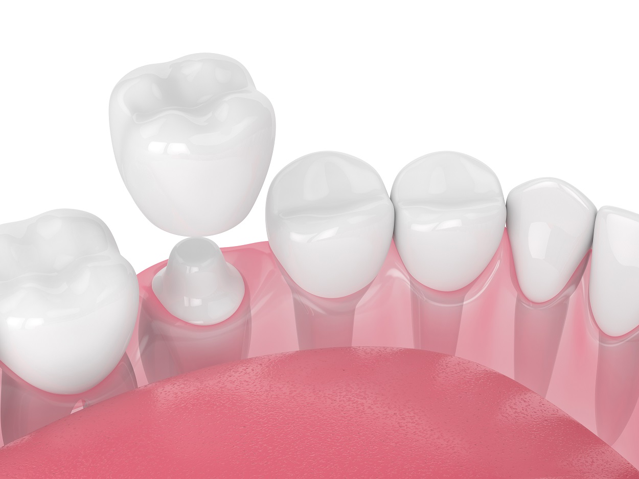 Featured image for “Dental Implants: Everything You Need to Know Before You Get One”