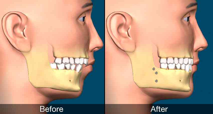 Featured image for “Jaw Straightening Surgery  Options”