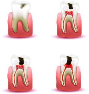 progression of a cavity