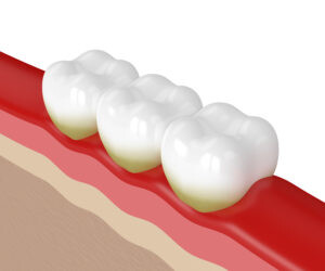 teeth with plaque and red gums from gingivitis