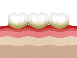 teeth with plaque and gum disease signs