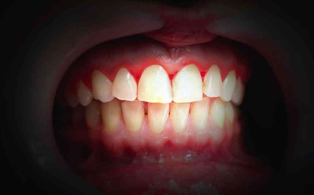 Featured image for “Bleeding Gums Treatments That Don’t Hurt”